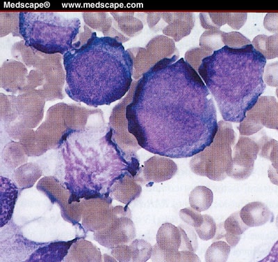 Acute Myeloid Leukemia. Acute Myeloid Leukemias .