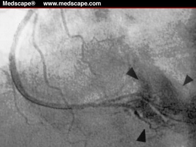 Successful Non Operative Management Of Right Coronary Artery Perforation