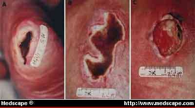 Eschar+tissue+pictures