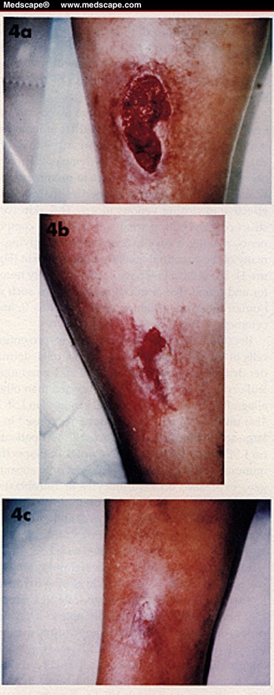 Epithelial Wound