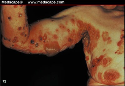 Bullous Skin Disease