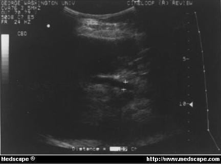 common bile duct size. dilated common bile duct