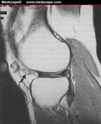 lateral meniscal tear,