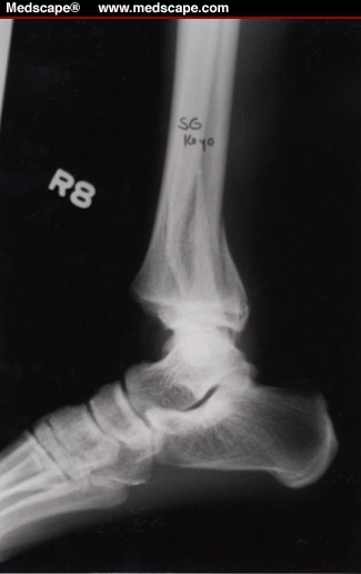 This fracture occurs at a