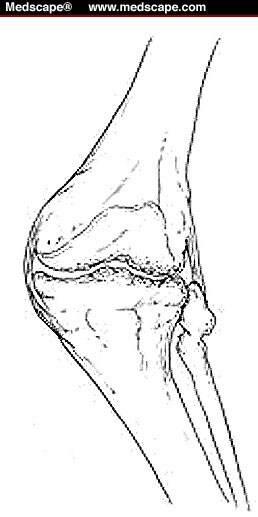 Valgus Deformity Knee