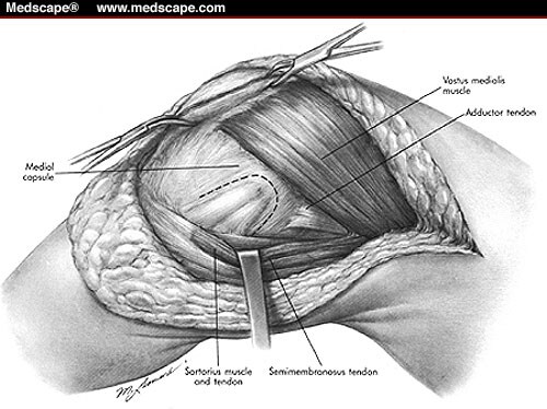 lateral release delineation