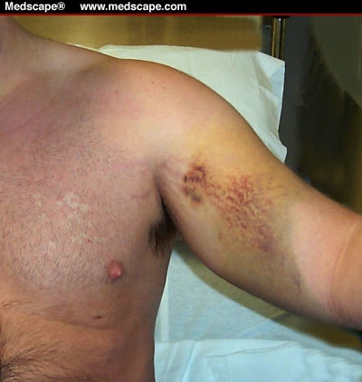 Muscle Strain Bruise