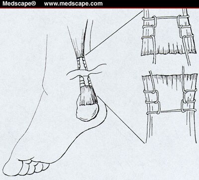 Achilles+tendon+rupture+repair