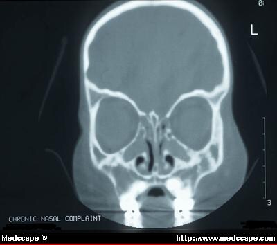 Opacified Sinus