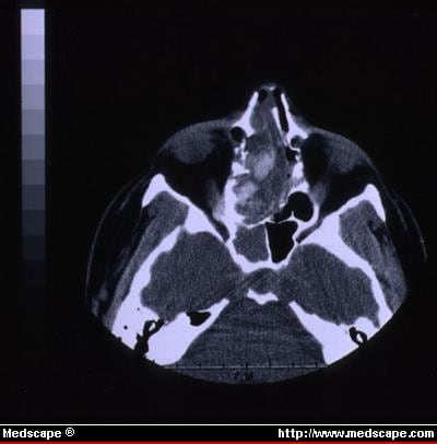 Fungal Sinusitis Ct