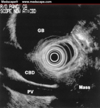 common bile duct ultrasound. common bile duct (CBD),