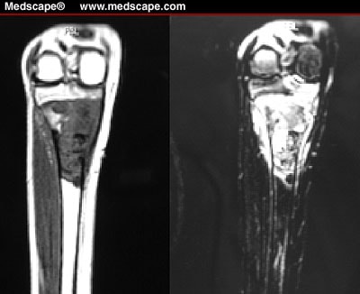 Osteo sarcoma photo tibia