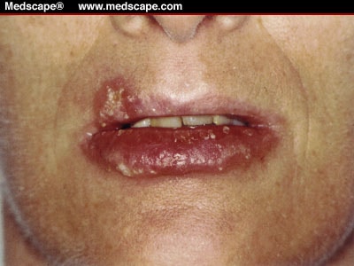 herpes simplex mouth. Severe hemorrhagic herpes