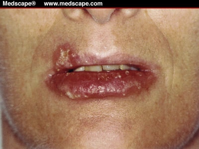 Severe hemorrhagic herpes