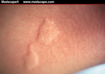 m1708.07.fig3 Latest Research Cures For Hives On Face