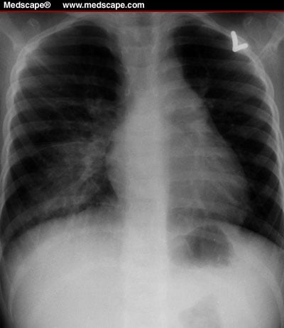 tuberculosis x ray. Chest x-ray film of a