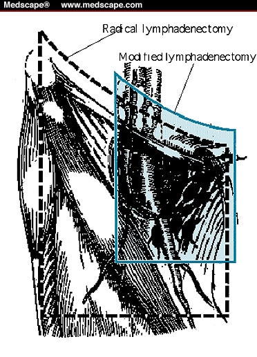 Inguinal Lymph Node Dissection For Penile Carcinoma 