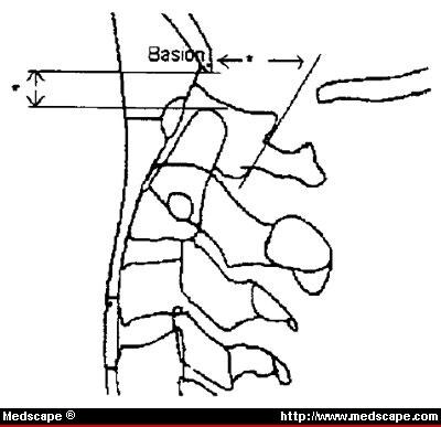 Cervical Spine Instability