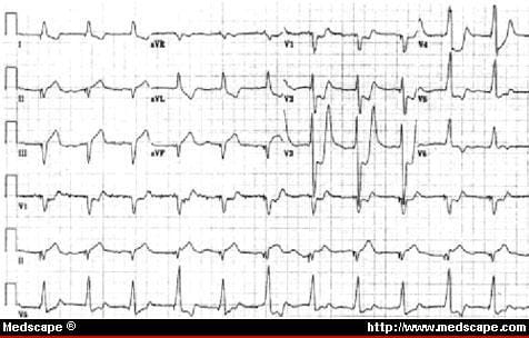 Ecg Posterior Mi