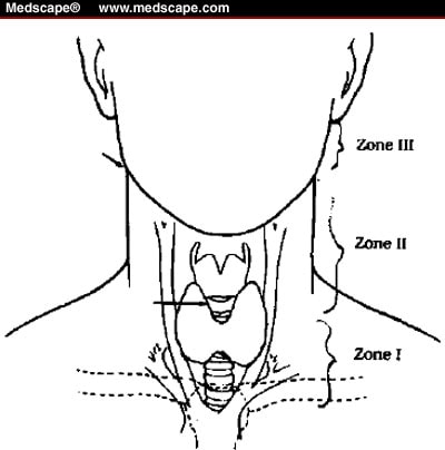 Surgical zones of neck.