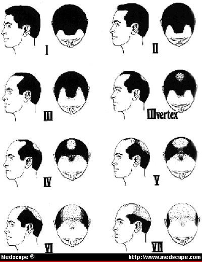 Male Hair Loss Classification: Hair Loss in Men ...