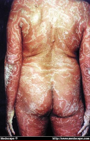 patterned rash