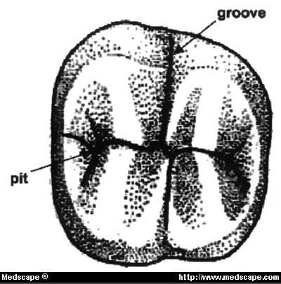 Tooth Pit