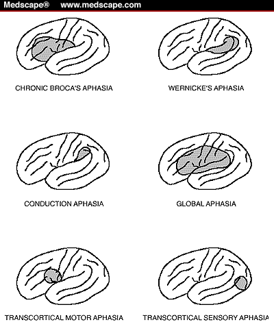 Types Of Aphasia