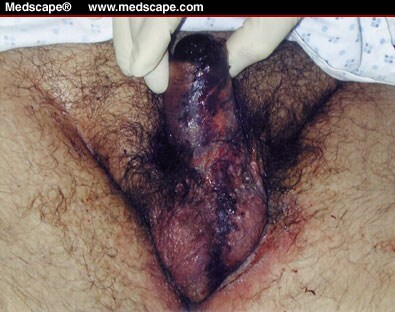 Figure 4. Progression of penile ischemic changes despite aggressive