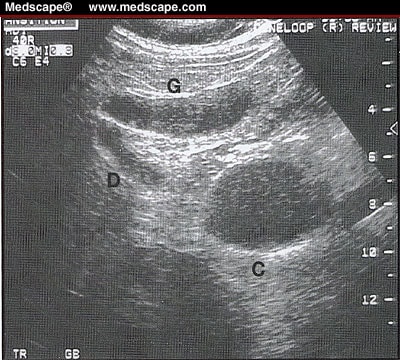 gallstones on ultrasound. Abdominal ultrasound disclosed