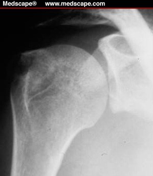 fractures part fracture tuberosity humeral greater proximal classification figure cuff rotator cariati evaluation orif often choice treatment