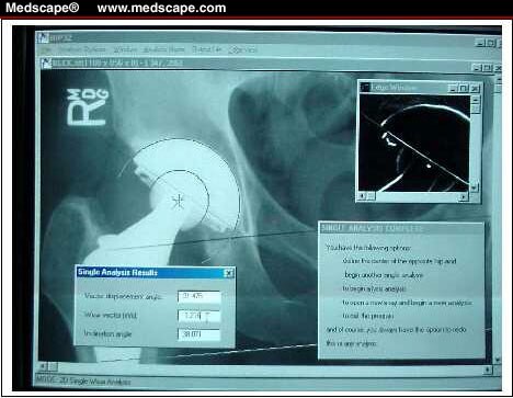 Charnley Prosthesis