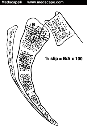 isthmic spondylothesis isthmic spondylothesis