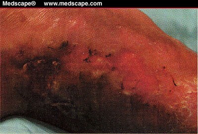 foot discoloration pictures