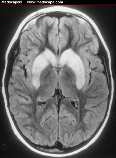 mri brain scan. T2-weighted MRI scan of the