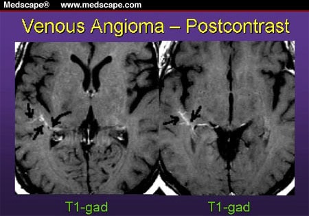 small angioma