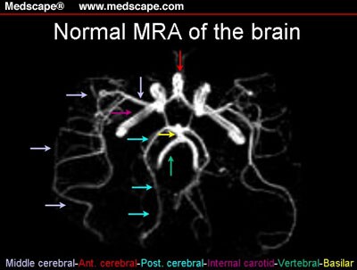 remedy stroke ringan