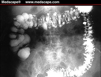 Numerous diverticula are