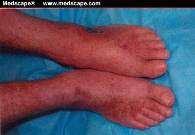 pitted edema