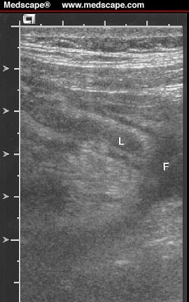 appendicitis on ultrasound