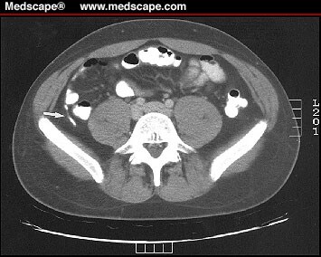 Appendix Ct Scan