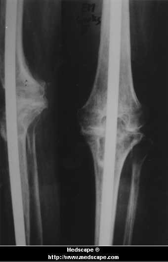 Knee Arthrodesis