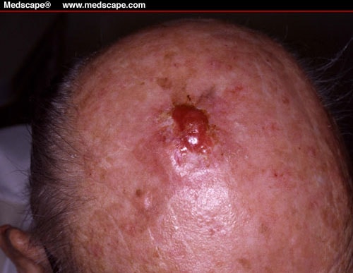 desmoplastic neurotropic melanoma