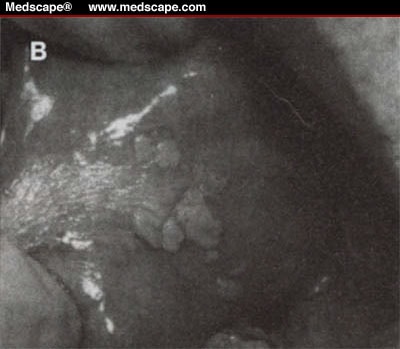 common warts pictures. A, Flat wart due to human