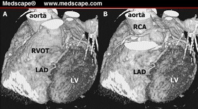 Three-Dimensional Coronary Anatomy