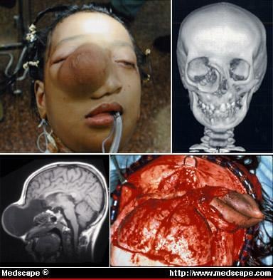 skull tumor