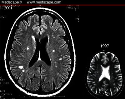 Agnosia on Case 14  Headache And Unilateral Visual Changes  Physical Exam