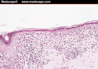 malignant melanoma pathology