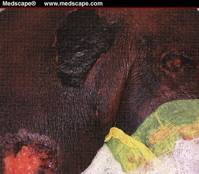 Calciphylaxis Wound