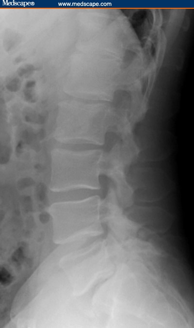 Isthmic Spondylolisthesis